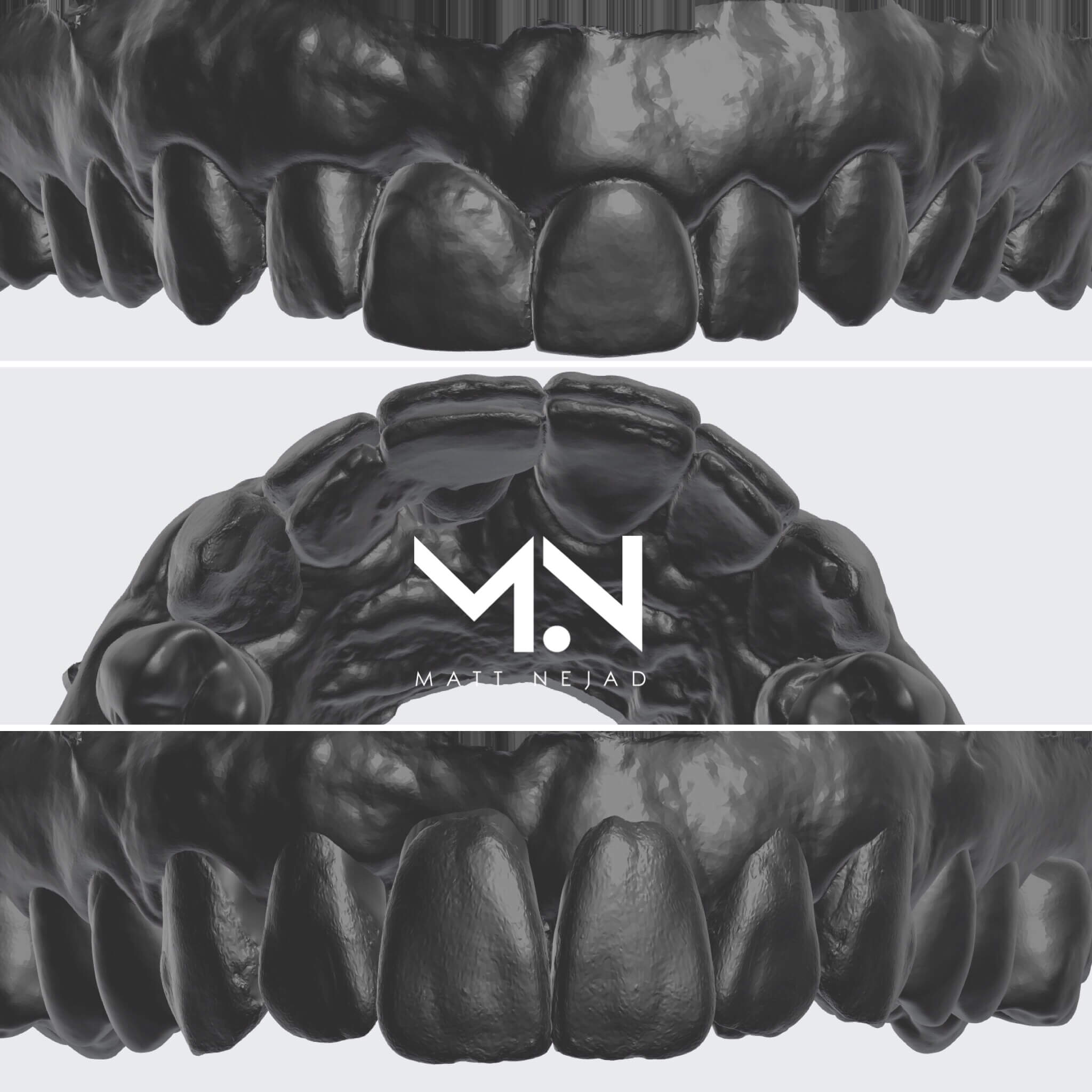 STL files before and after digital smile design is completed.