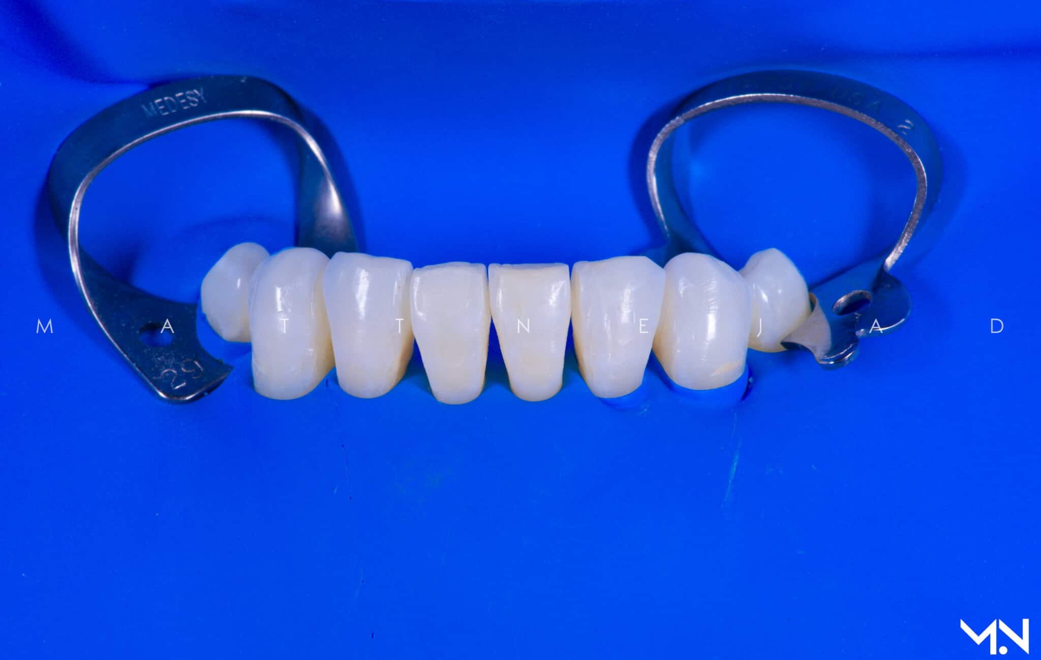 rubber dam for veneers