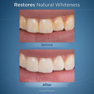 Waterpik Whitening Stain Removal Before and After