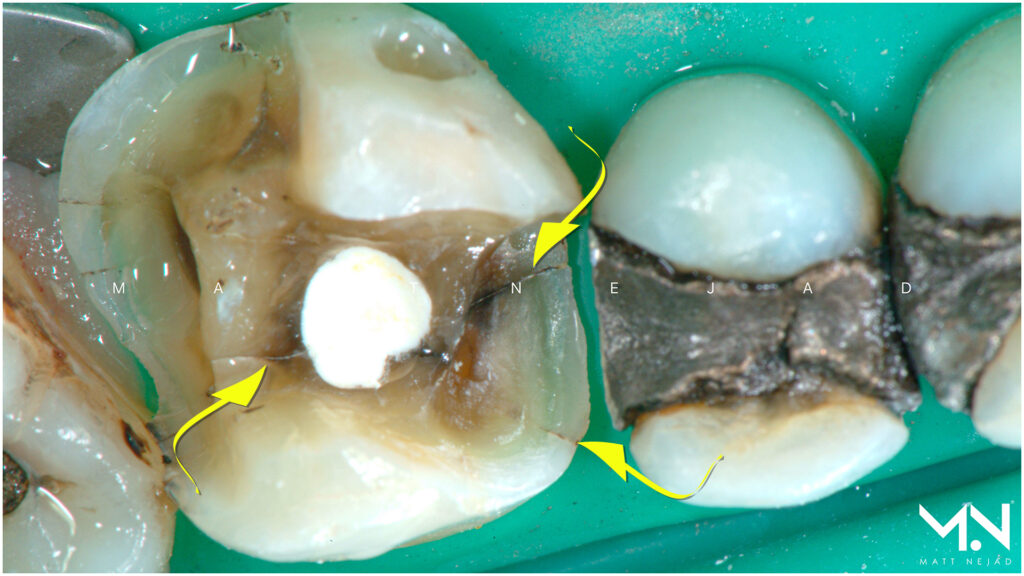 Cracked tooth caused by a silver filling