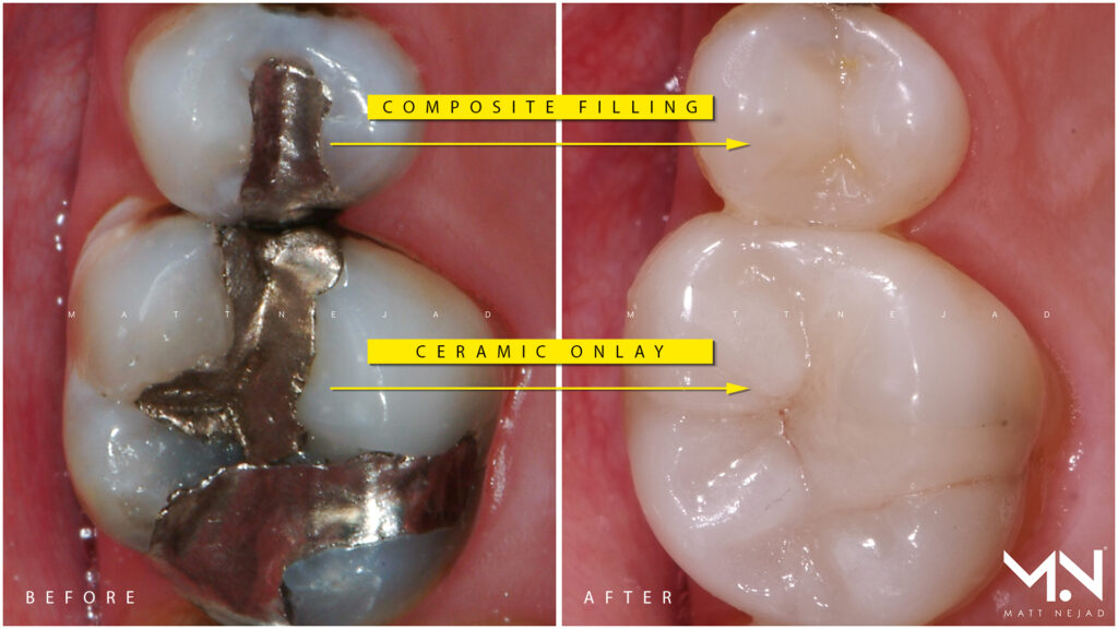 Replacement options for silver fillings