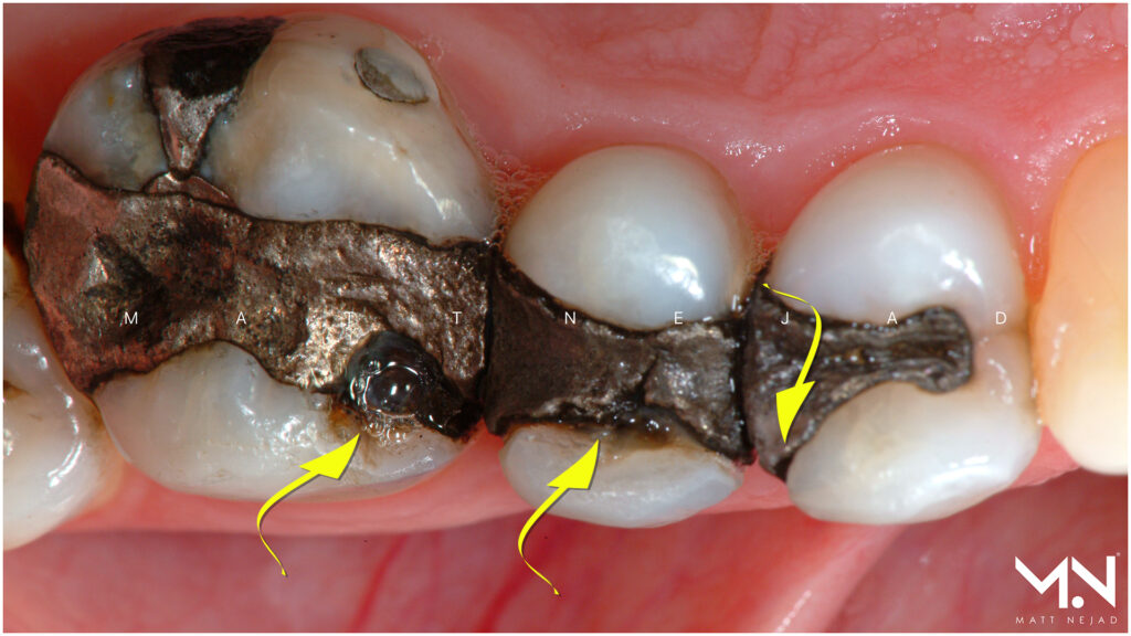 Silver filling with cracks and gaps around margins