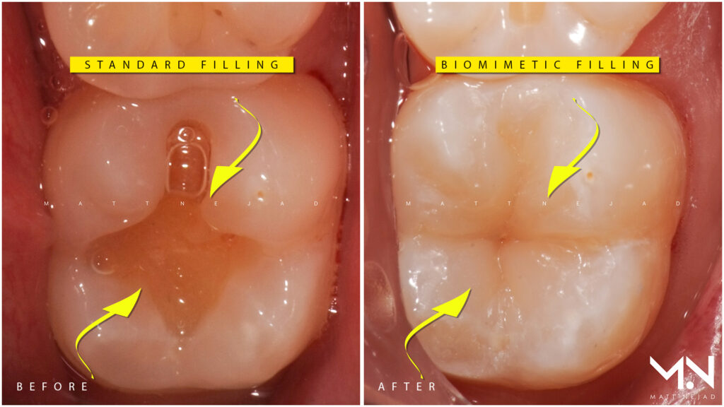 White filling on the left replaced with a biomimetic filling on the right side. 