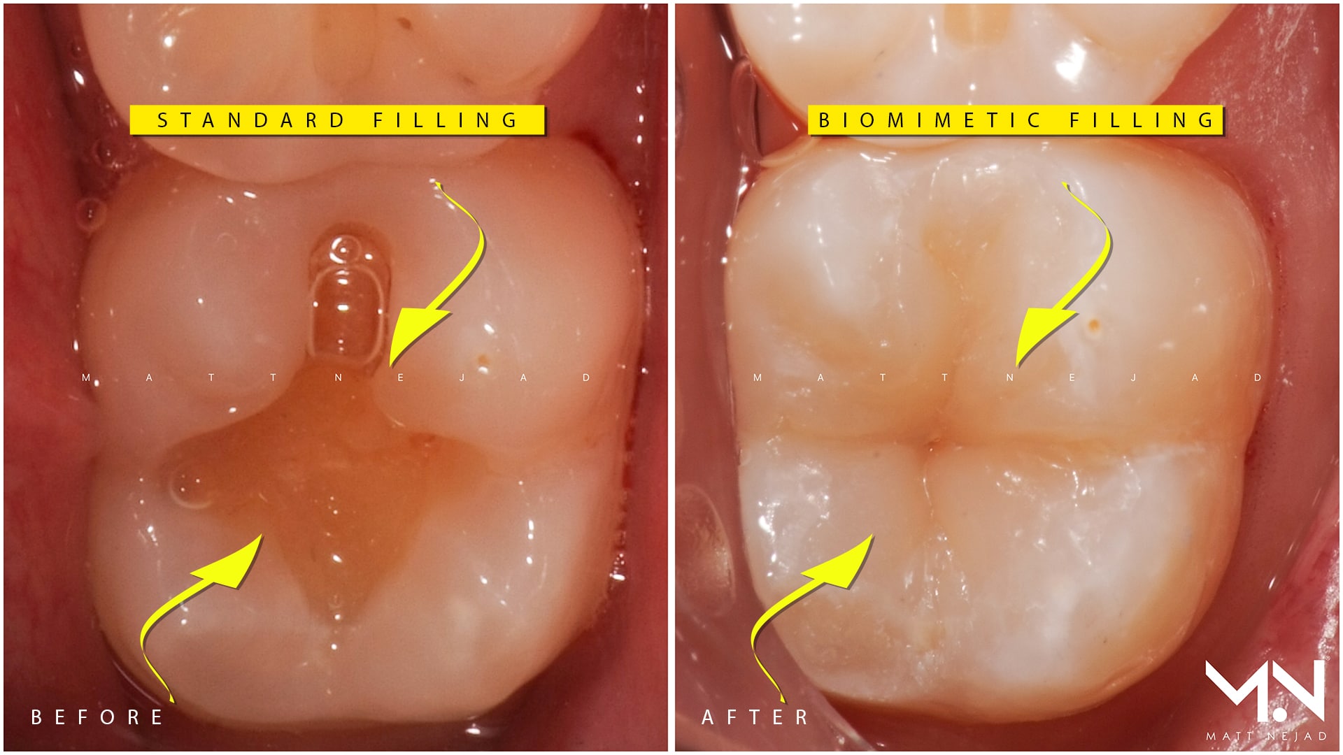 How to Fix a High Filling at Home 