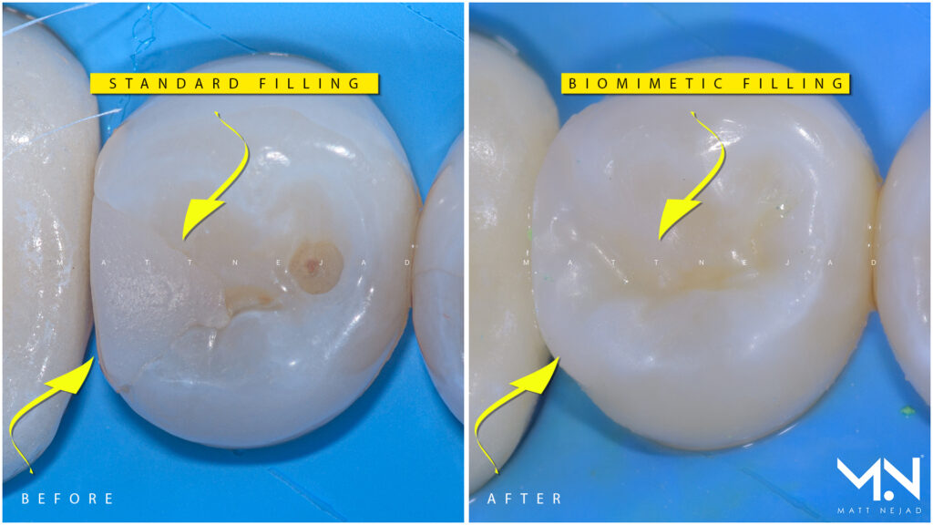 Example of Standard white filling vs Biomimetic Composite restoration