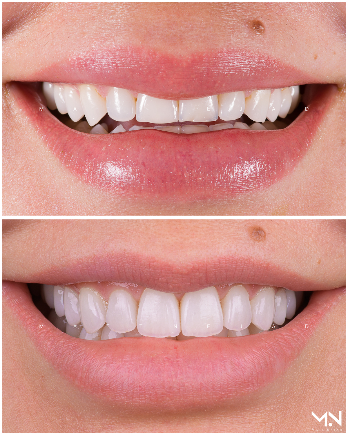 Closeup before & after smile of 10 veneers