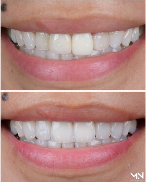 Closeup before & after of 6 veneers