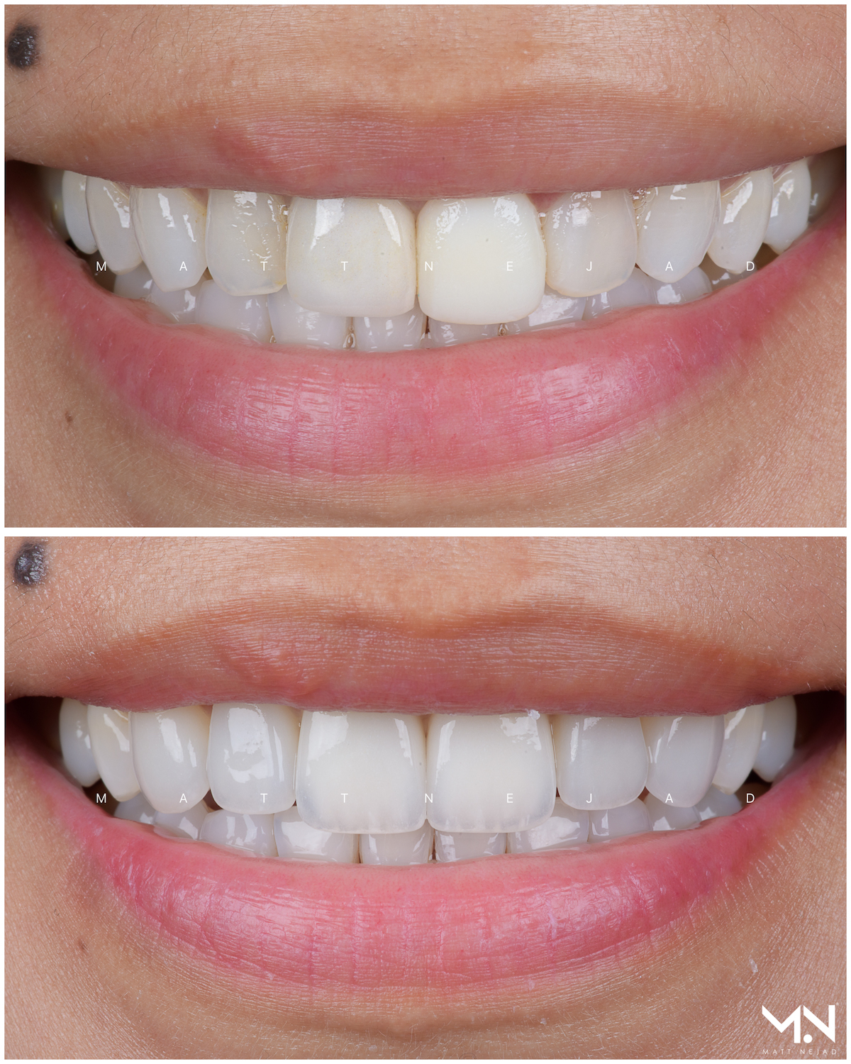 Closeup before & after of 6 veneers