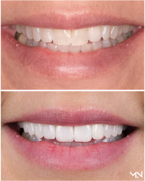 Closeup before & after- 10 veneers