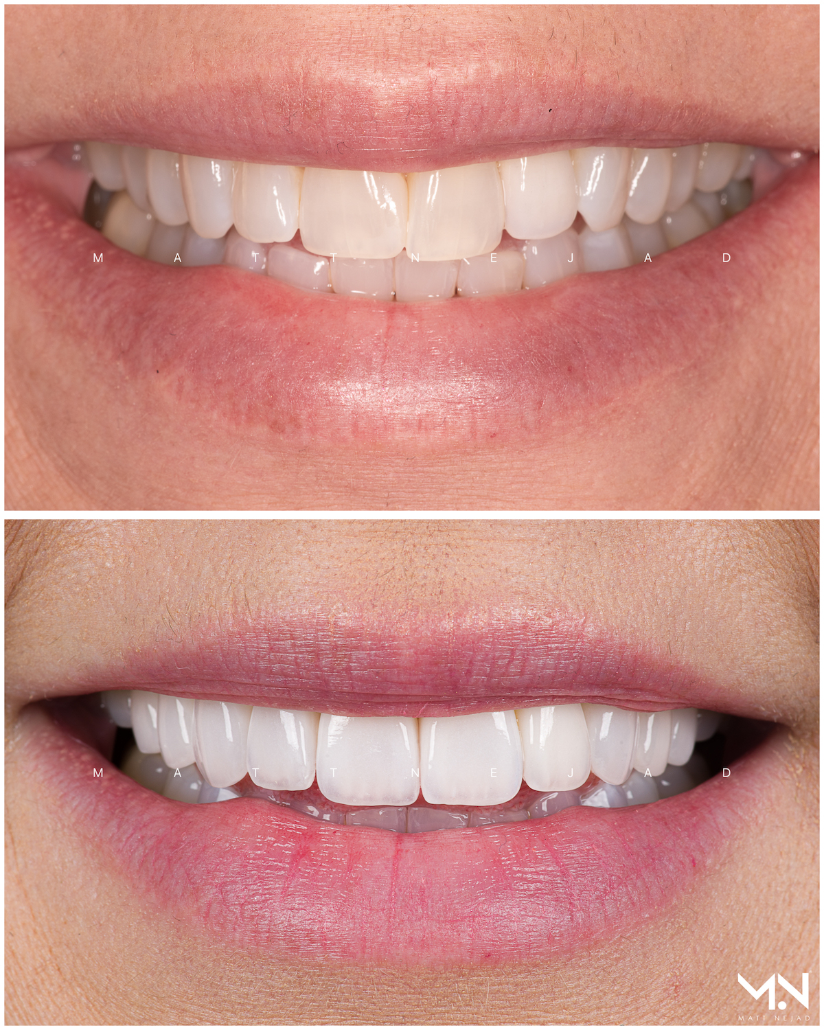 Closeup before & after- 10 veneers