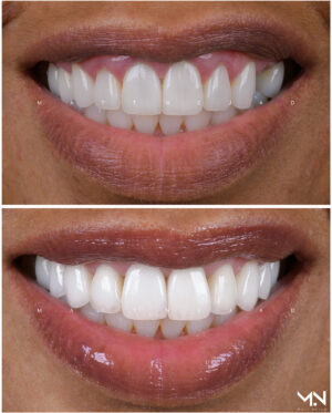 Closeup before & after of 10 veneers