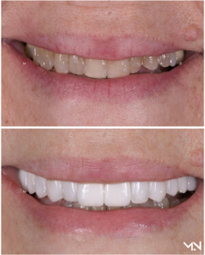 Closeup before & after- of 13 veneers & crowns