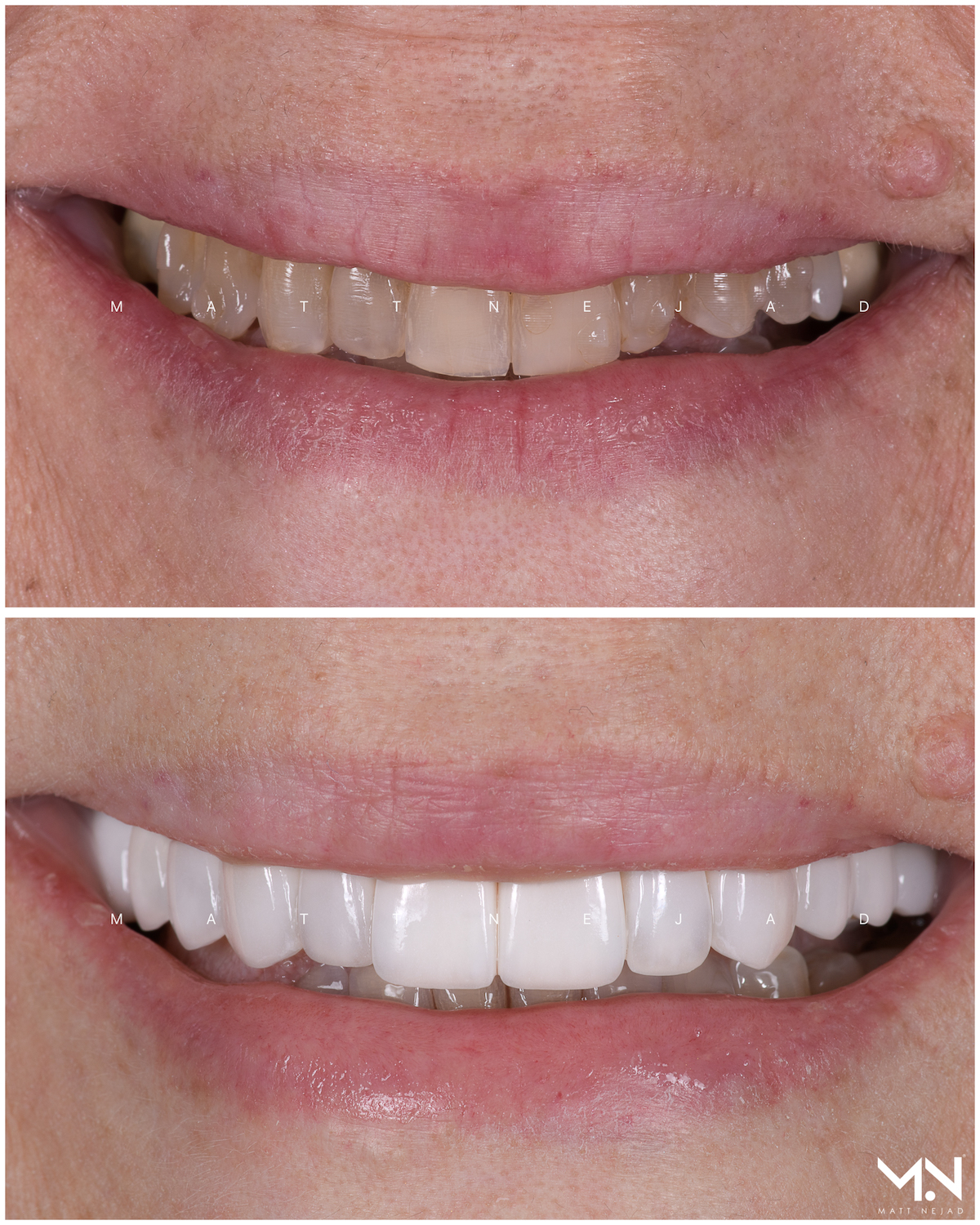 Closeup before & after- of 13 veneers & crowns