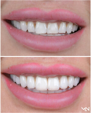 Closeup before & after of 10 veneers