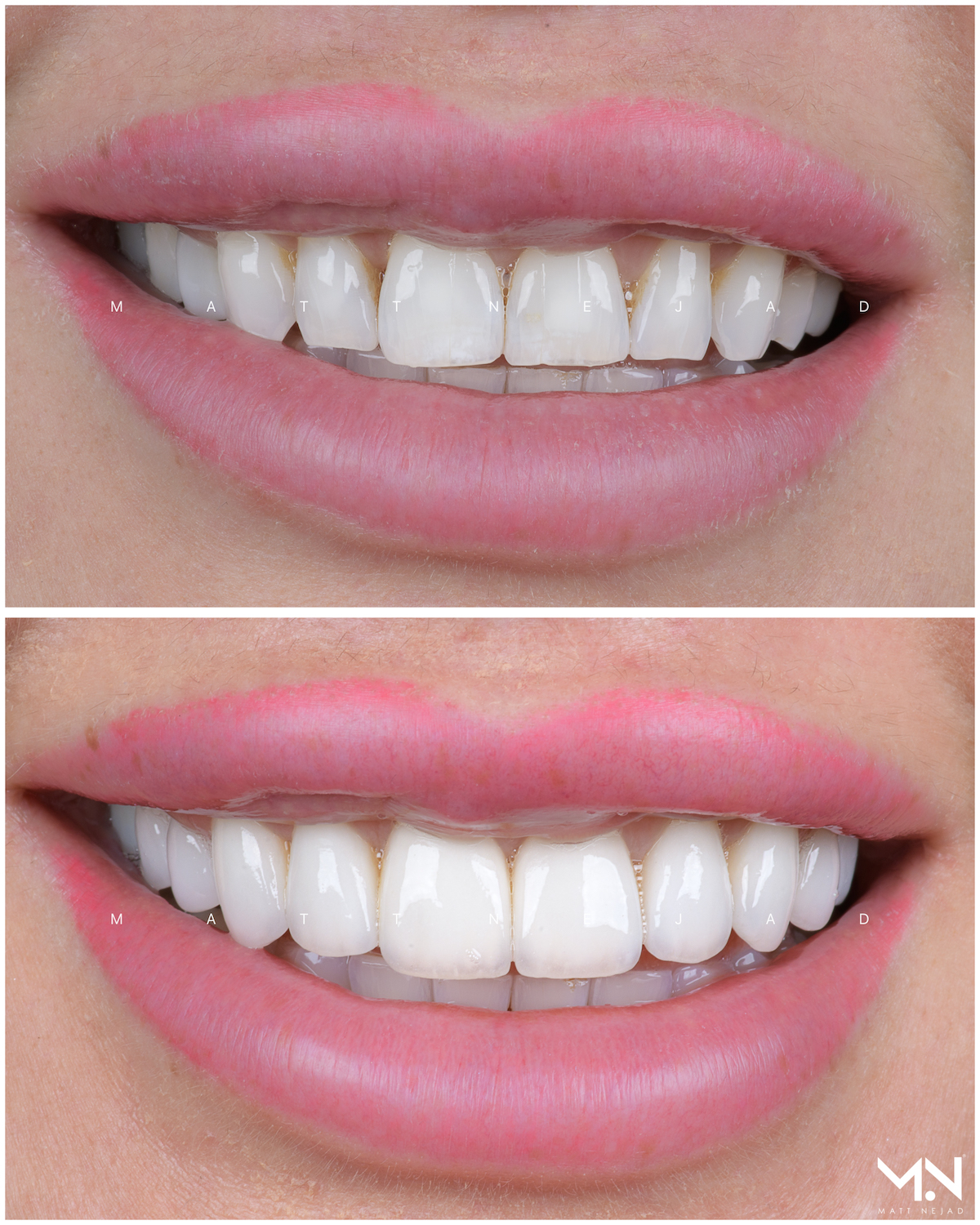 Closeup before & after of 10 veneers