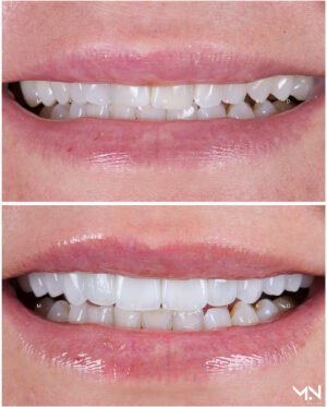 Closeup before & after of 10 veneers