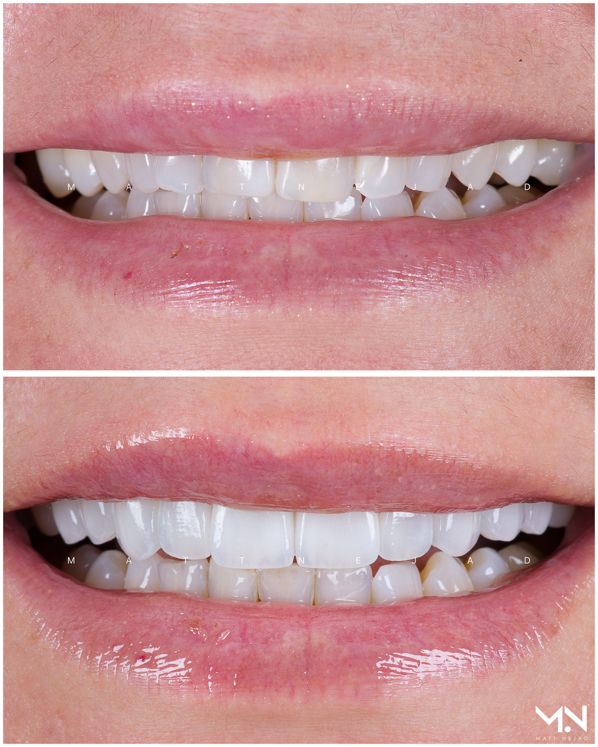 Closeup before & after of 10 veneers