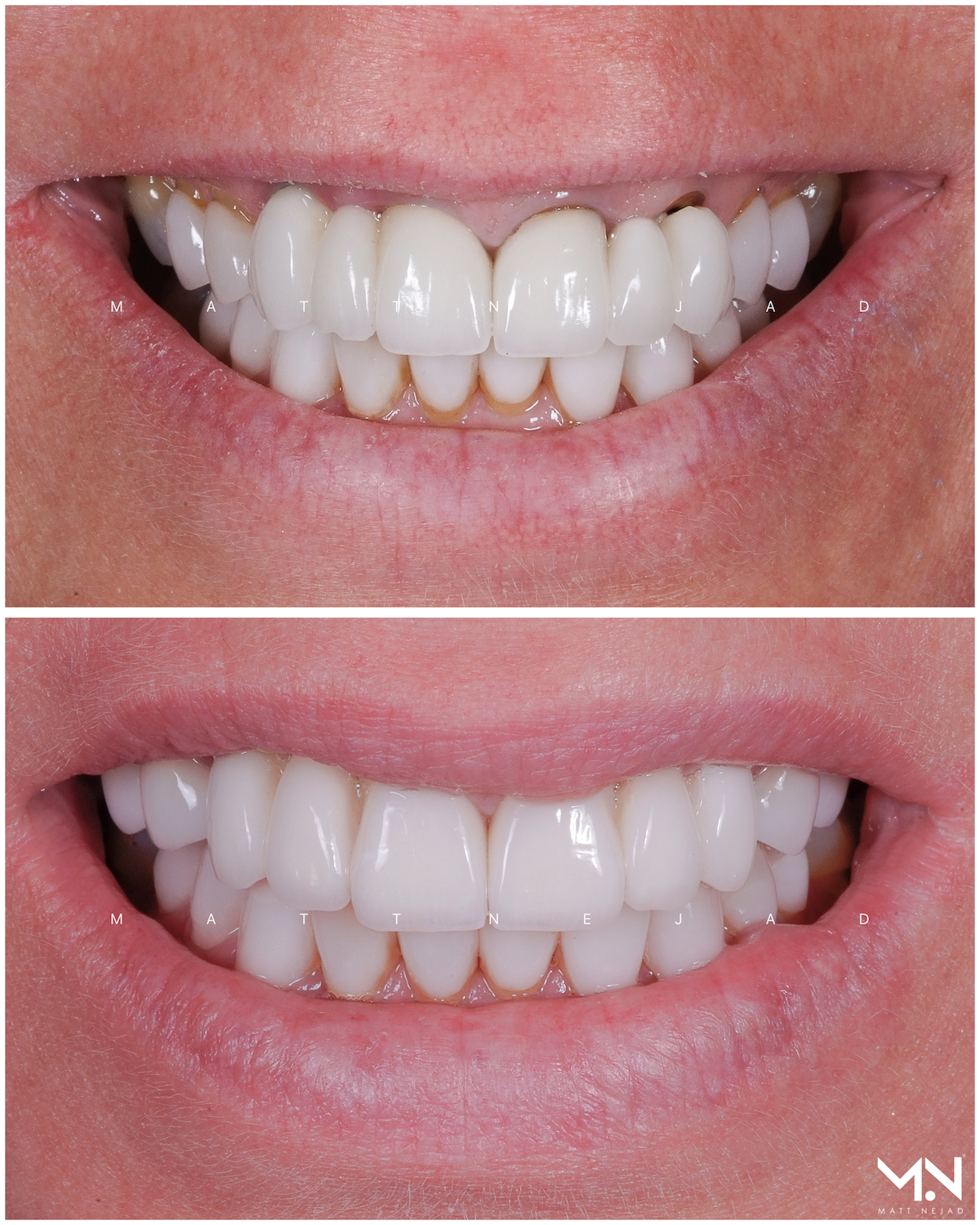 Closeup before & after - bridge & veneers