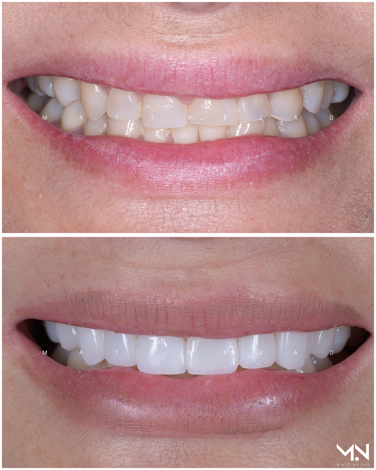 Closeup before & after - smilemakeover- upper