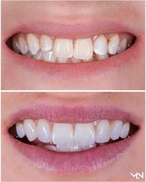 Closeup before & after- 4 veneers