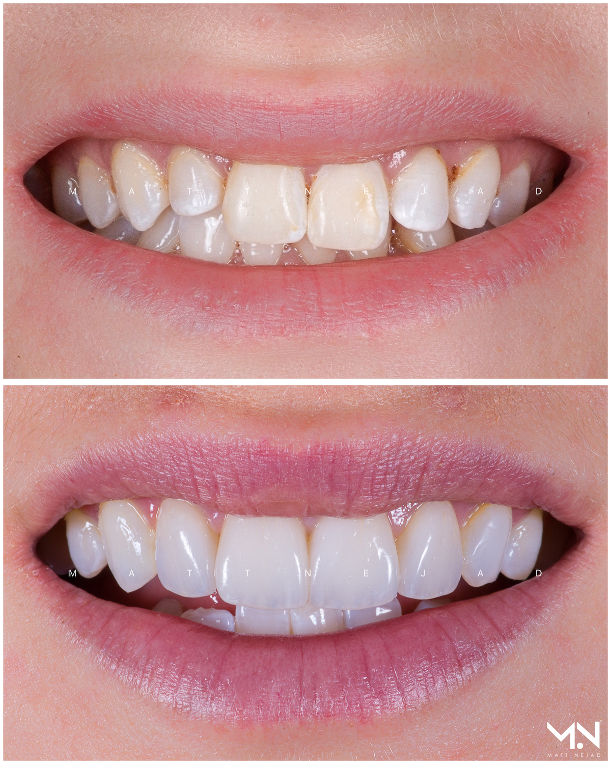 Closeup before & after- 4 veneers