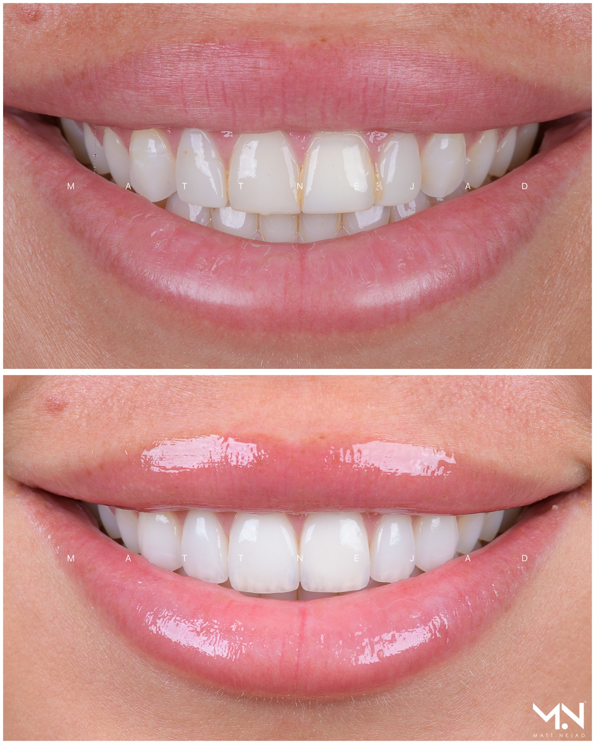 Closeup before & after of 6 veneers