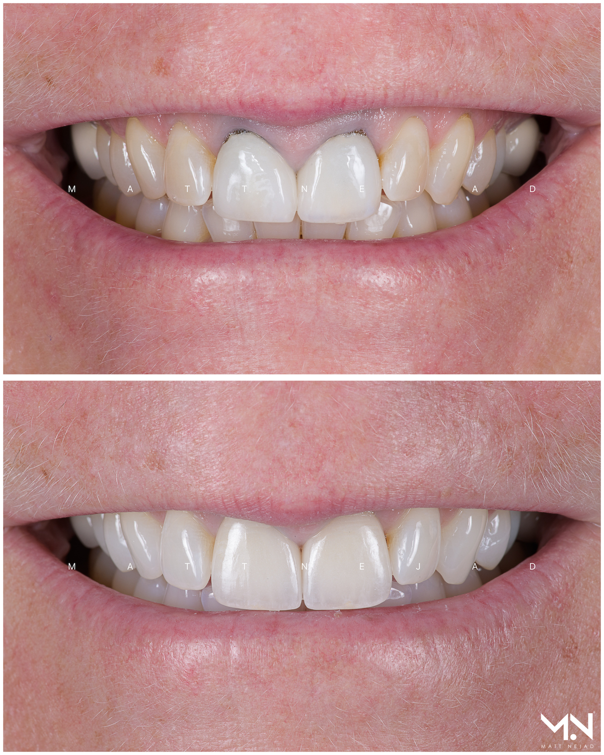 Closeup before & after-2 crowns