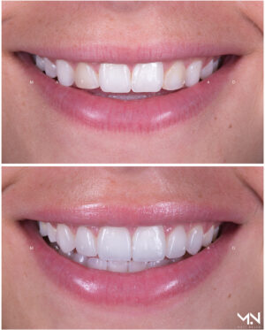 Closeup before & after-6 veneers