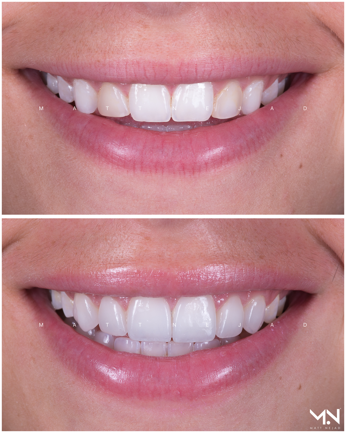 Closeup before & after-6 veneers