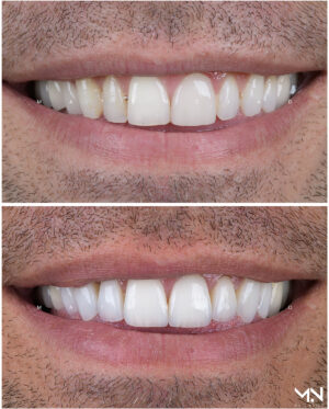 Closeup before & after- 8 veneers