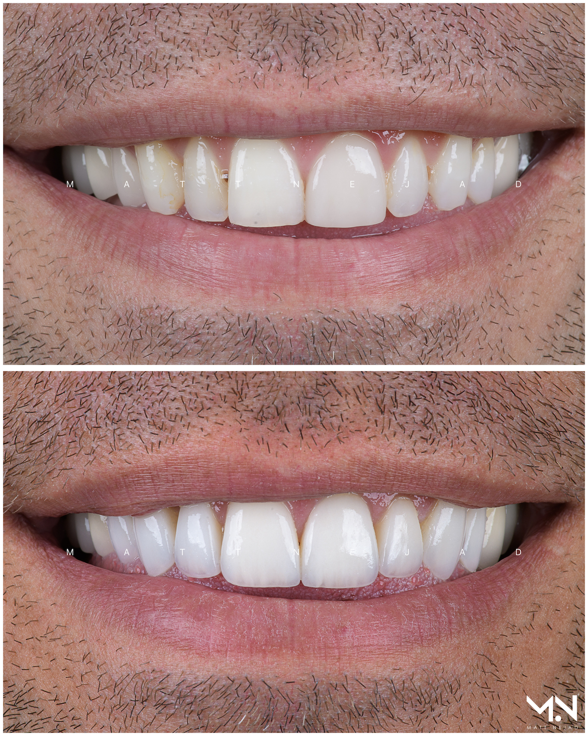 Closeup before & after- 8 veneers