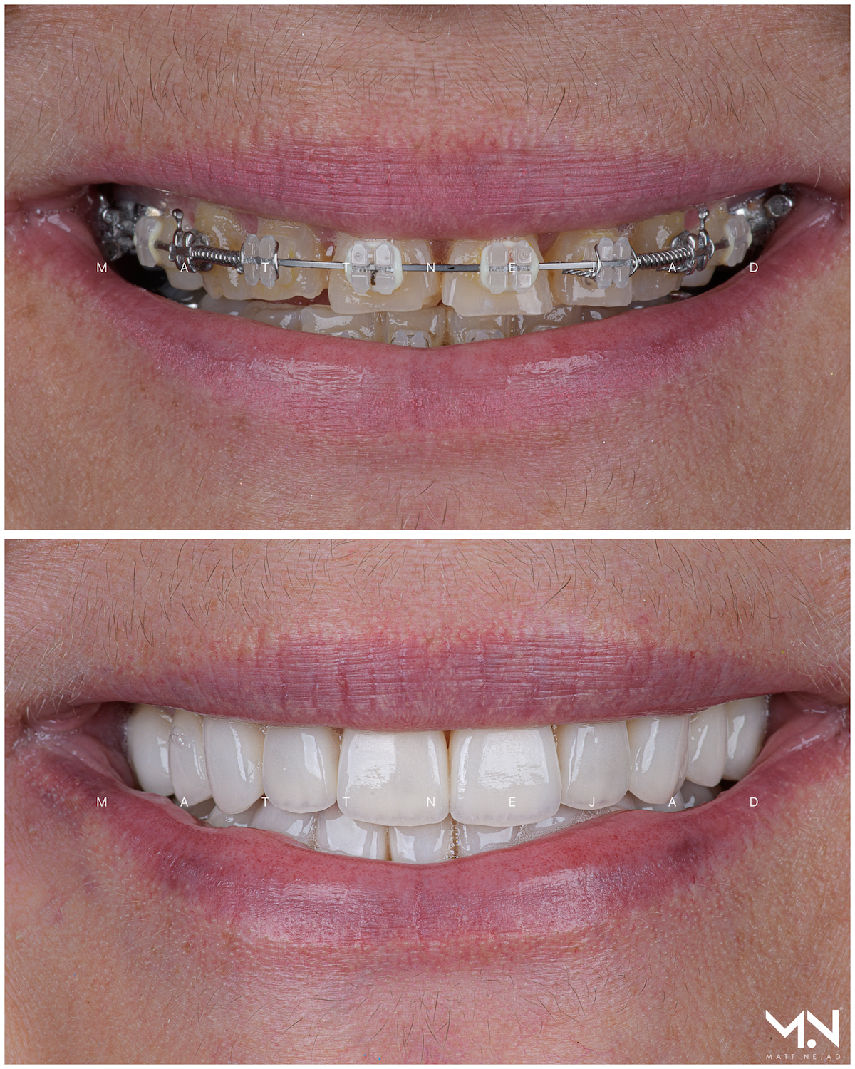 Closeup before & after-Full Mouth Reconstruction