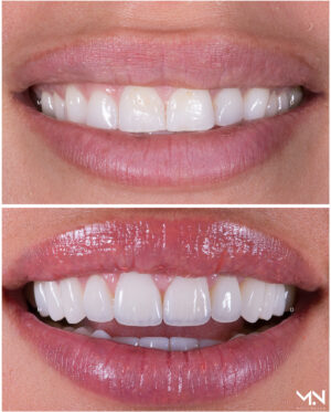 Closeup before & after-10 veneers