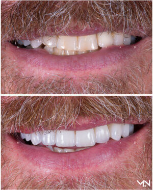 Closeup before & after-10 veneers