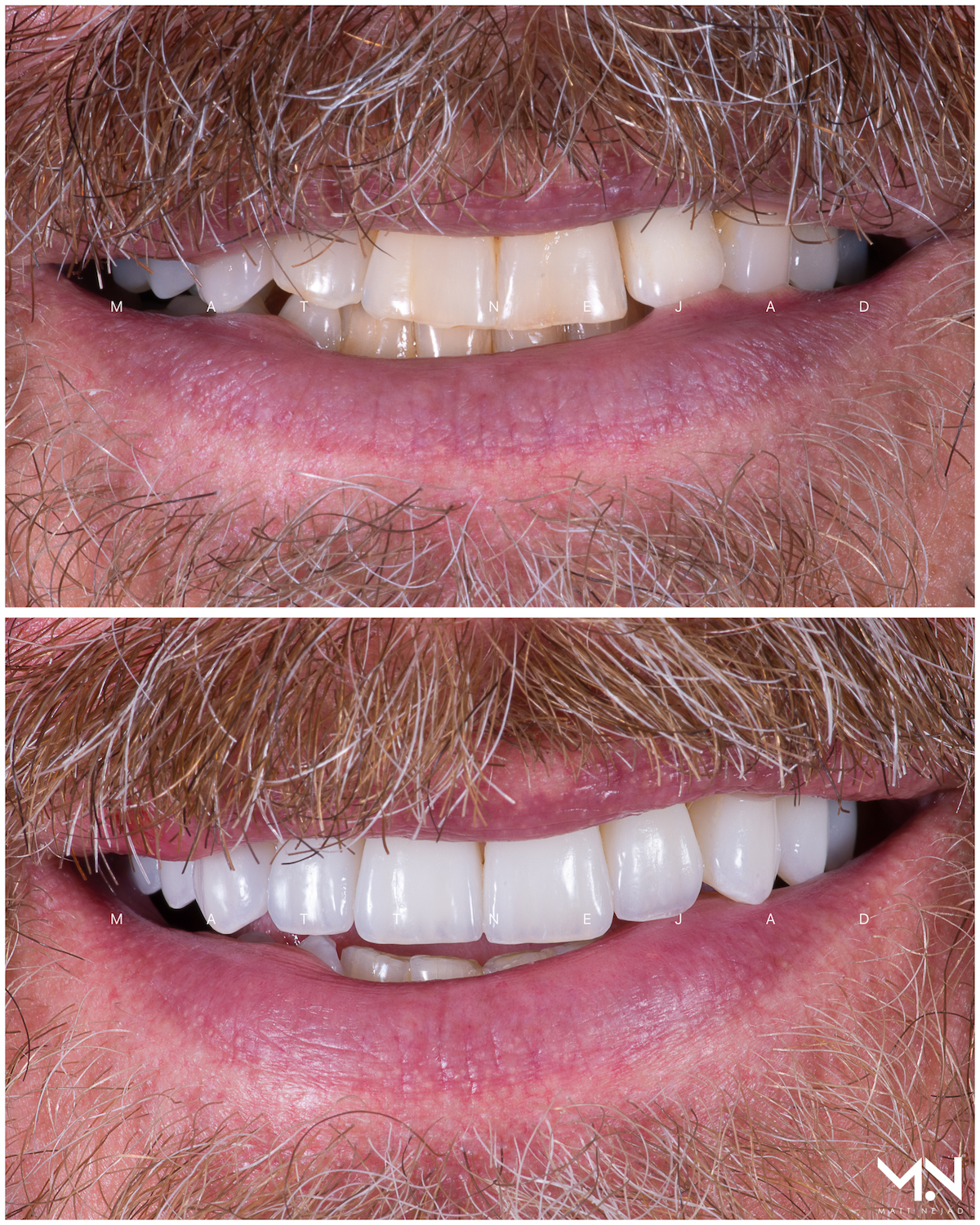 Closeup before & after-10 veneers