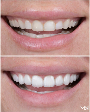 Closeup before & after of 10 veneers