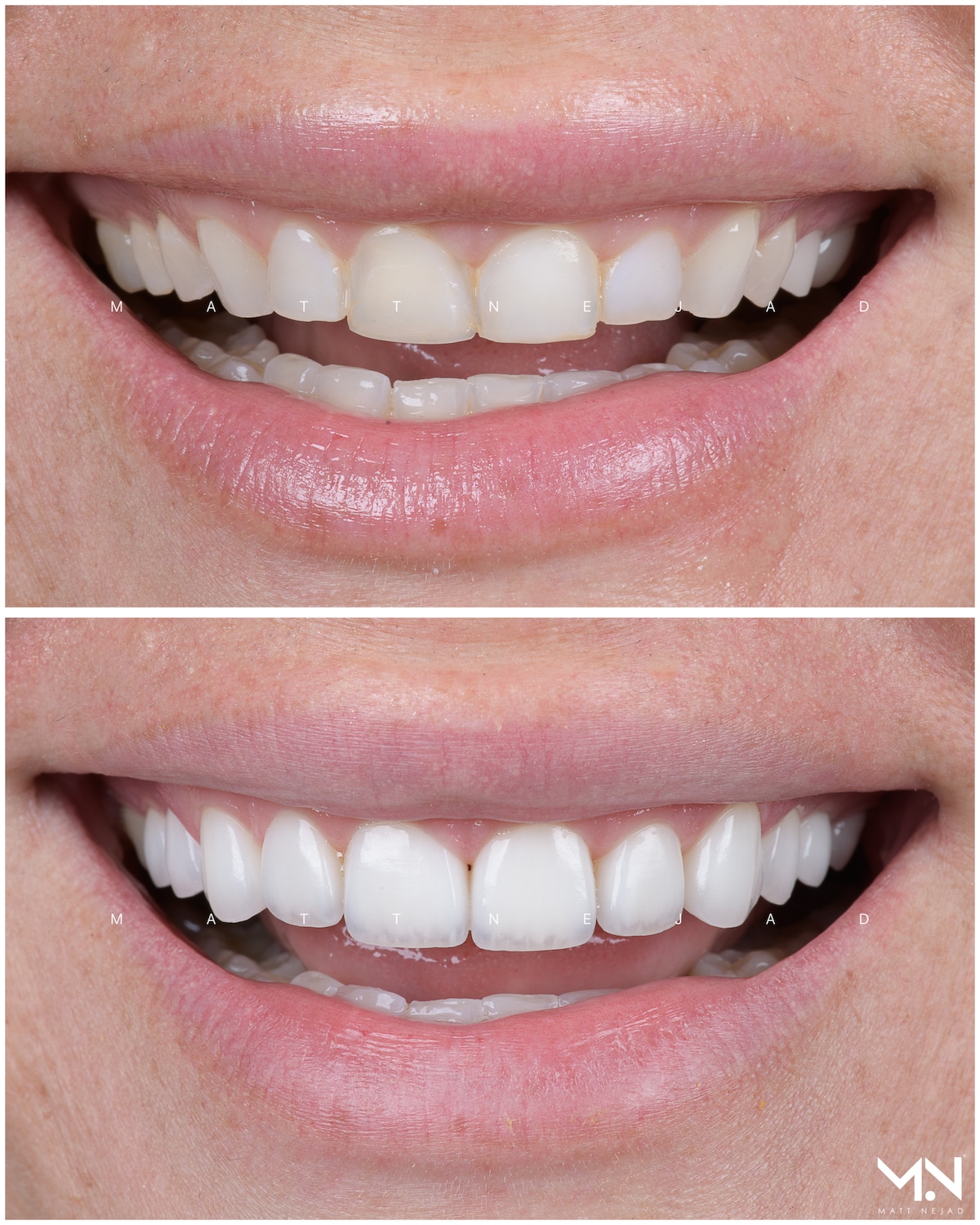 Closeup before & after of 10 veneers