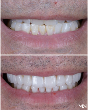 Closeup before & after of 20 veneer smilemakeover