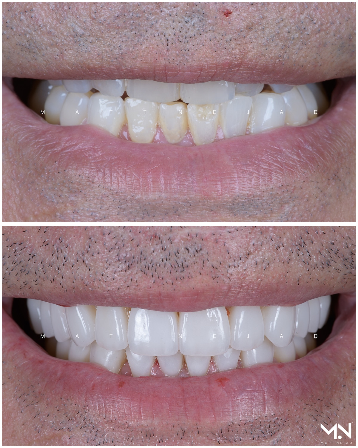 Closeup before & after of 20 veneer smilemakeover