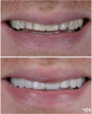 Closeup before & after of 10 veneers