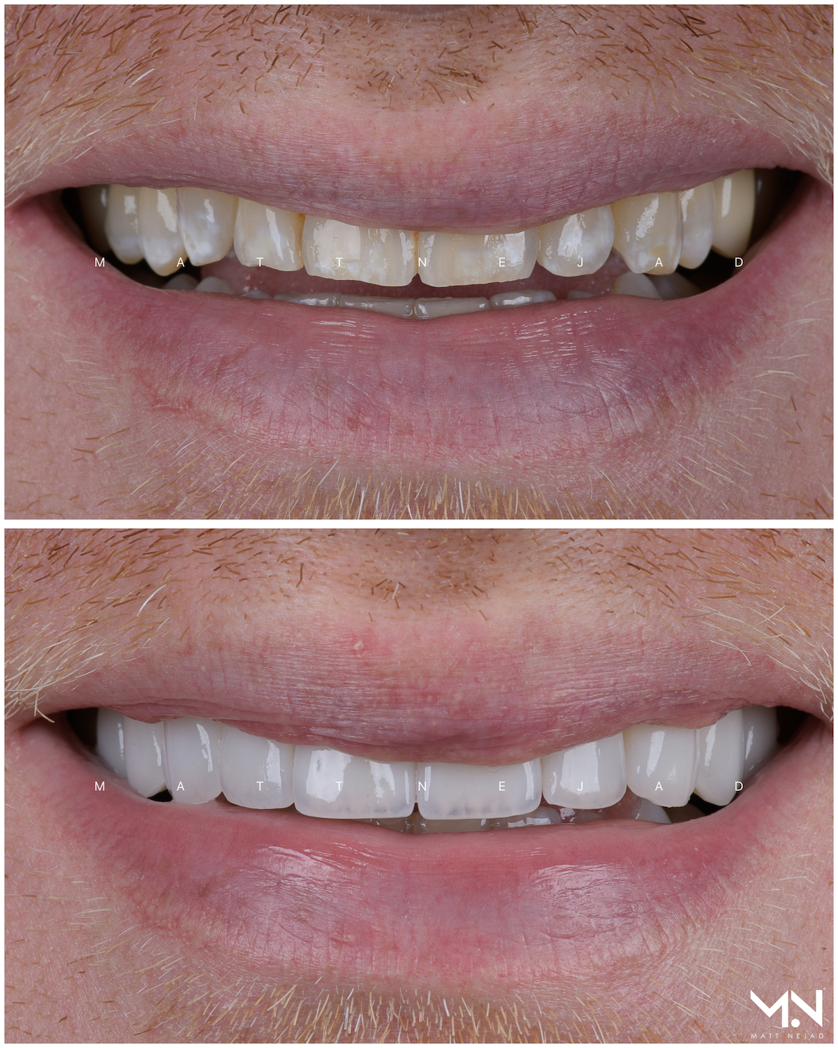 Closeup before & after of 10 veneers