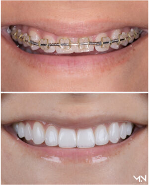 Closeup before & after of 10 veneers