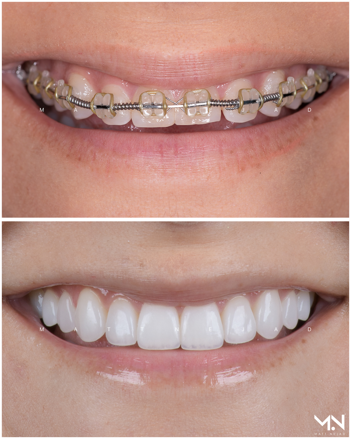 Closeup before & after of 10 veneers