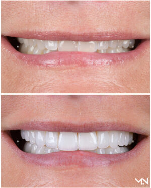 Closeup before & after of 20 veneer smile makeover