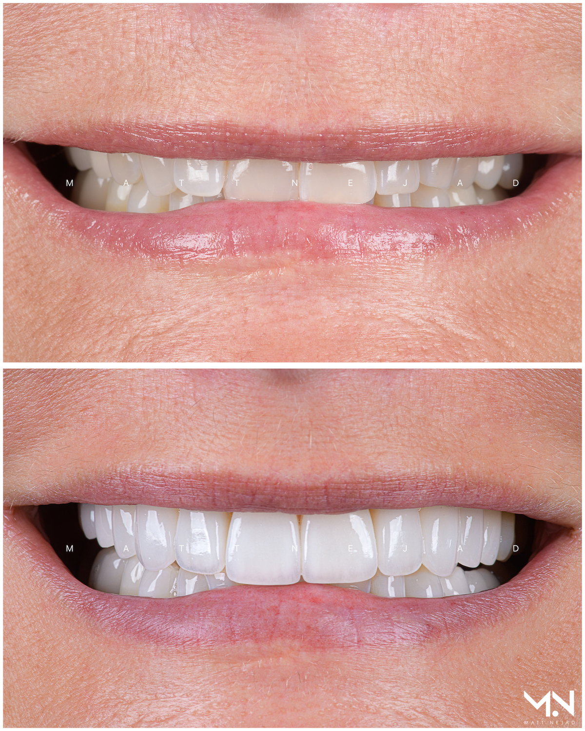 Closeup before & after of 20 veneer smile makeover