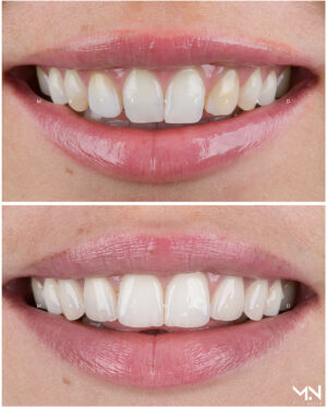 Closeup before & after smile of 6 veneers