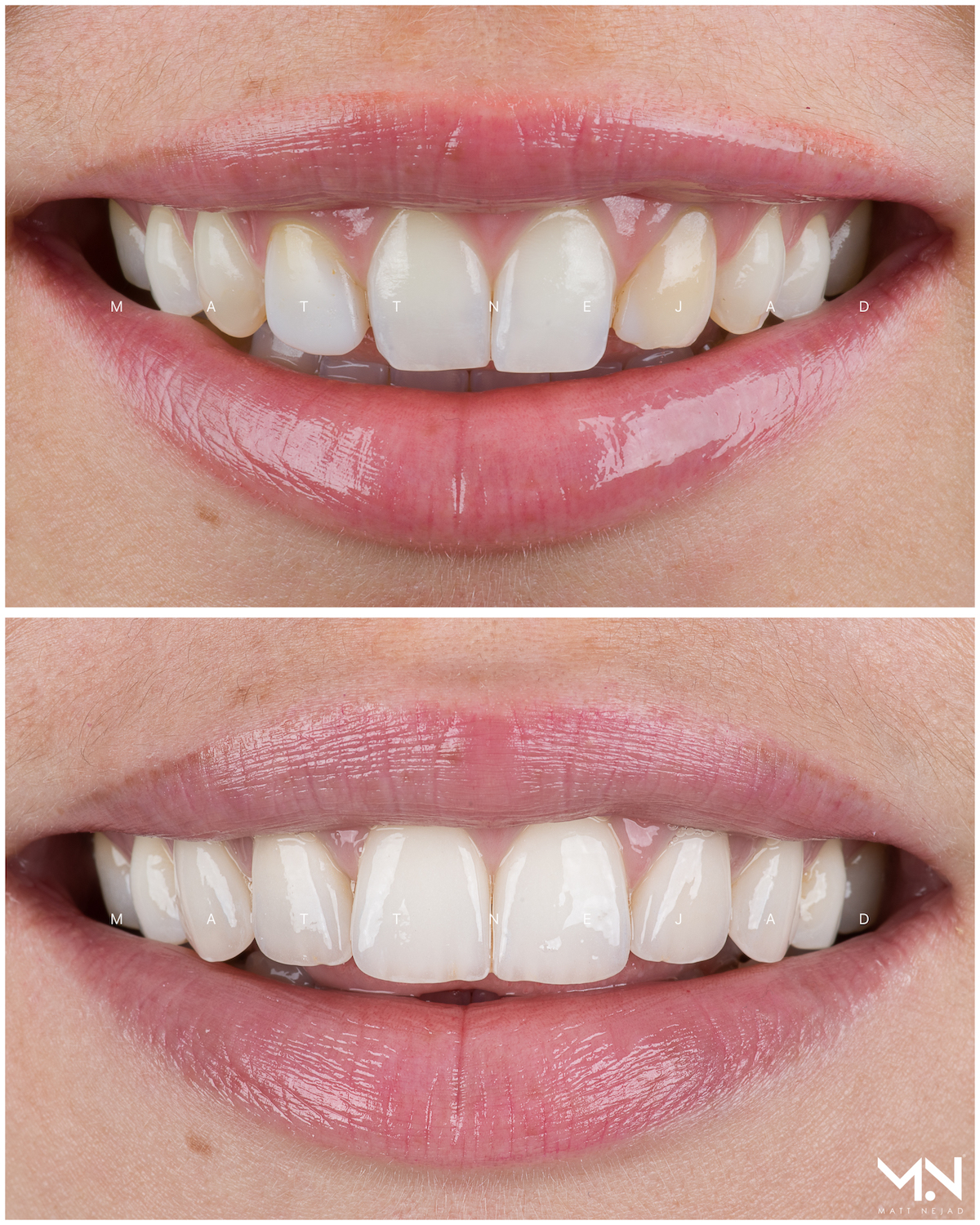 Closeup before & after smile of 6 veneers
