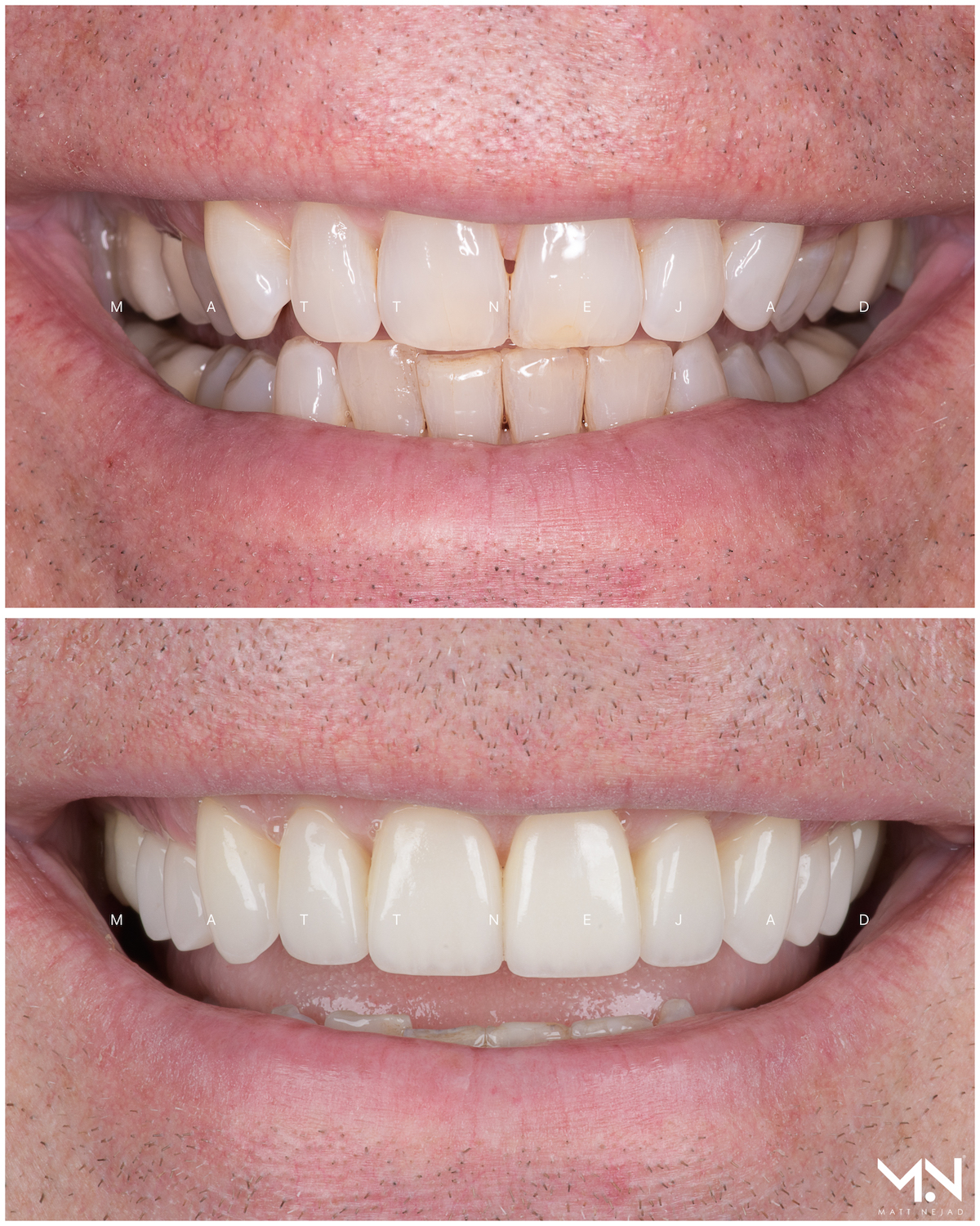 Closeup before & after of 10 veneers