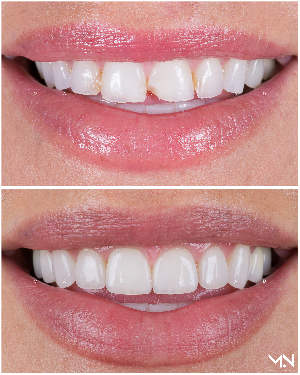 Closeup before & after smile of 10 veneers
