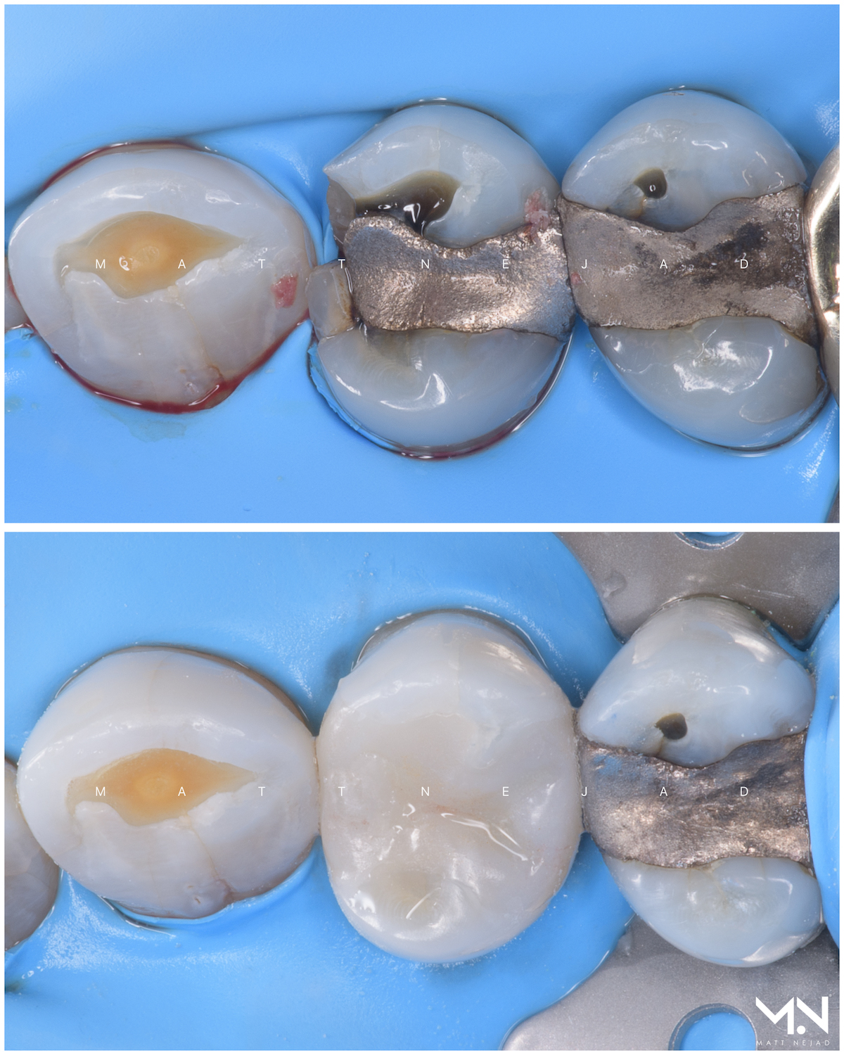 Biomimetic restoration - Replace failed silver filling with a ceramic inlay